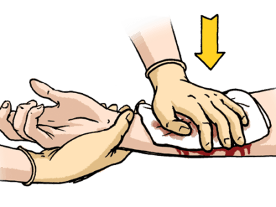 tlak krvaceni 400x300 037d924db8