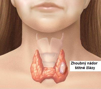 jak-se-projevuje-rakovina-stitne-zlazy-priznaky-projevy-symptomy