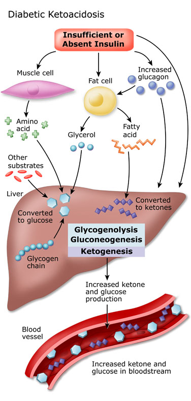 diabetic-ketoacidosis
