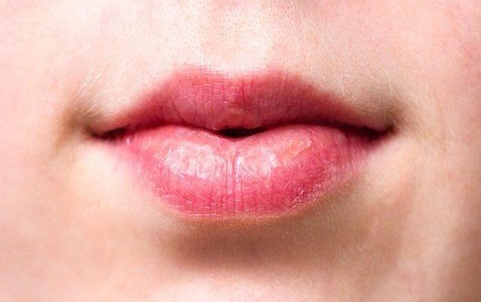 dry-chapped-lips-700x440