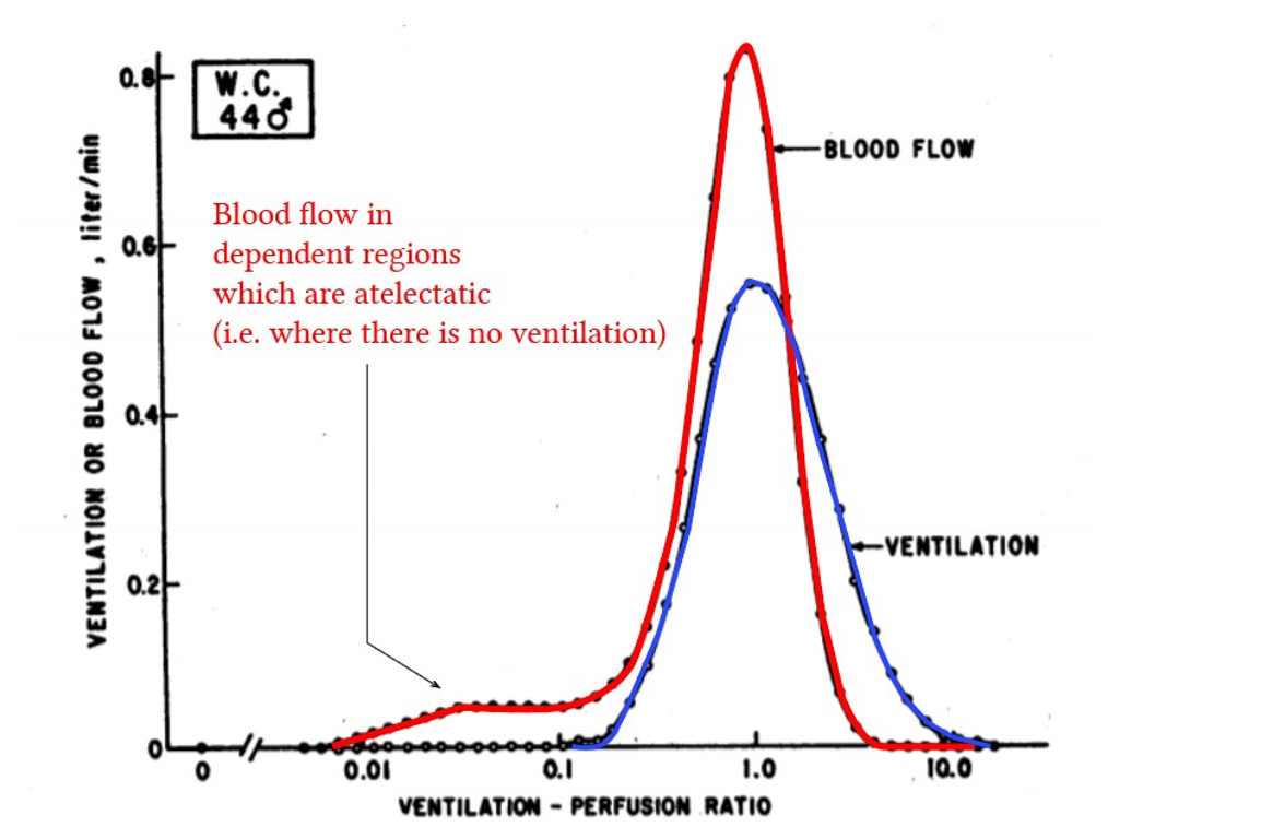 Ventilation-to-perfusion disorders