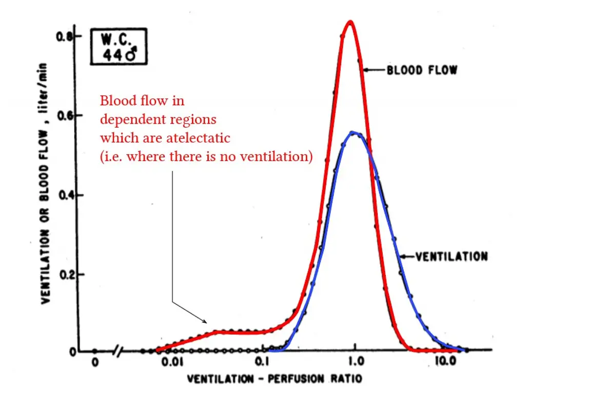 Ventilation-to-perfusion disorders